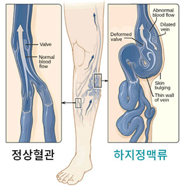 정상혈관과 하지정맬규 혈관 차이