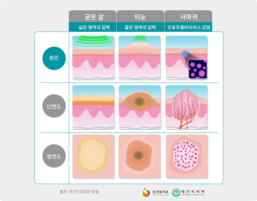 굳은살, 티눈, 사마귀의 원인, 단면도, 평면도